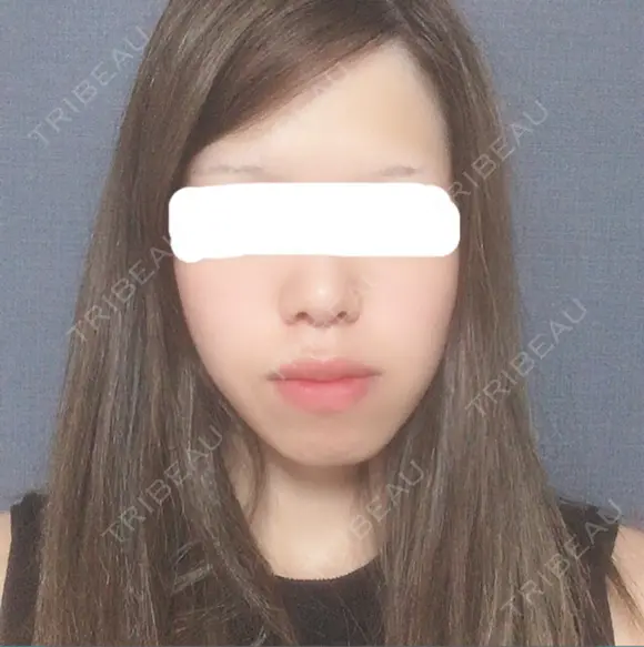 糸リフト / バッカルファット除去 / ボトックス（エラ・小顔） 湘南美容クリニック 静岡院 BEFORE メイン用