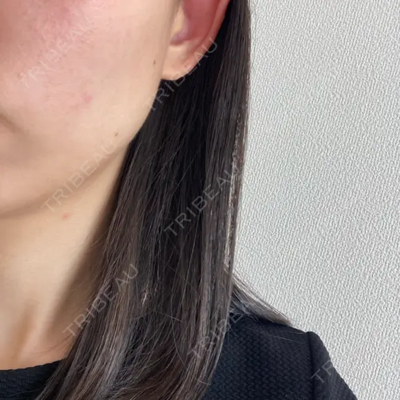 水光注射（ハリ・美肌） Rinato Beauty Clinic BEFORE メイン用