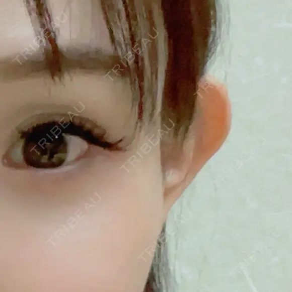 糸リフト / 目尻切開 / タレ目形成・グラマラスライン（切開） / ボトックス（あご） / ヒアルロン酸注入（あご） / ヒアルロン酸注入（鼻翼基部） Tokyo Tensei Clinic 新宿院 BEFORE メイン用