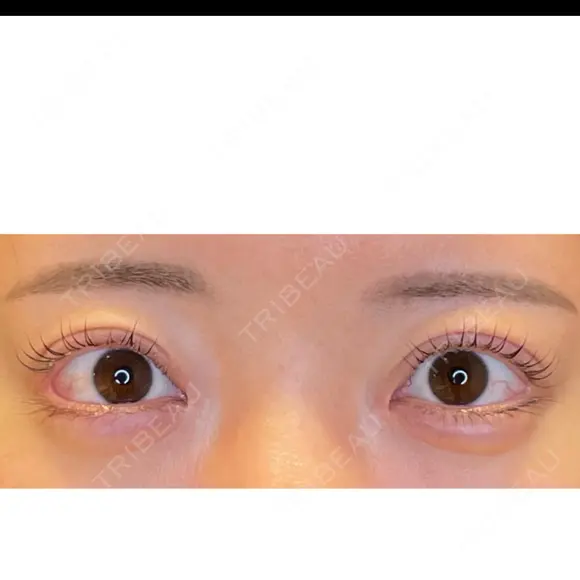タレ目形成・グラマラスライン（埋没） LOUIS CLINIC 二子玉川院【ルイクリニック】 BEFORE メイン用