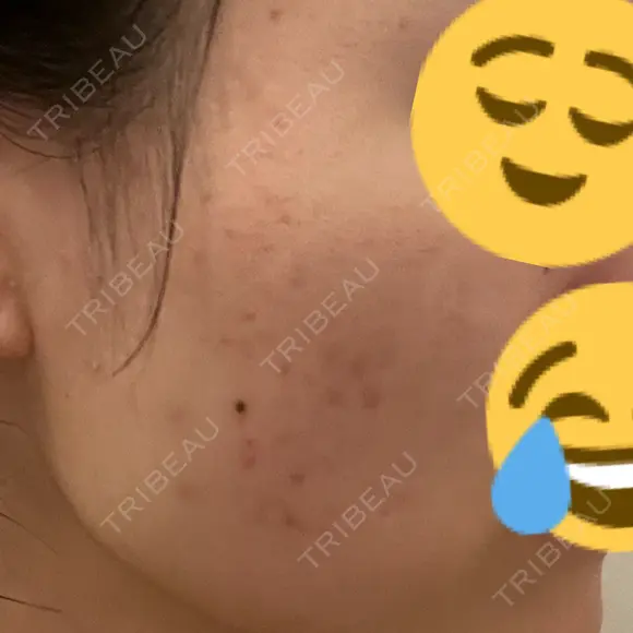 光治療（フォトフェイシャルなど） LUNA BEAUTY CLINIC 池袋駅前院 BEFORE メイン用