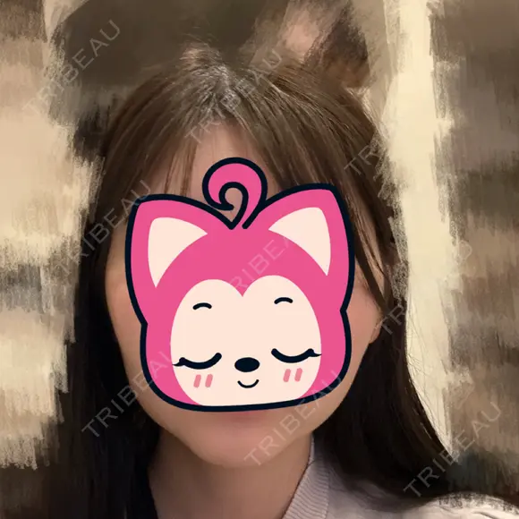 糸リフト / 脂肪吸引（顔） 脂肪吸引ラボトウキョウ BEFORE メイン用
