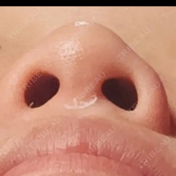 ヒアルロン酸注入（鼻） / ヒアルロン酸注入（鼻翼基部） プロジェクトユー医院 BEFORE メイン用