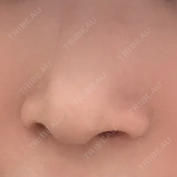 小鼻縮小（切開） キップン整形外科 BEFORE メイン用