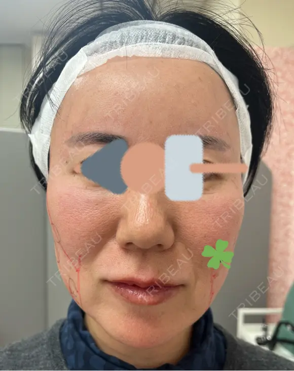 糸リフト Olino美容外科・美容皮膚科 BEFORE メイン用