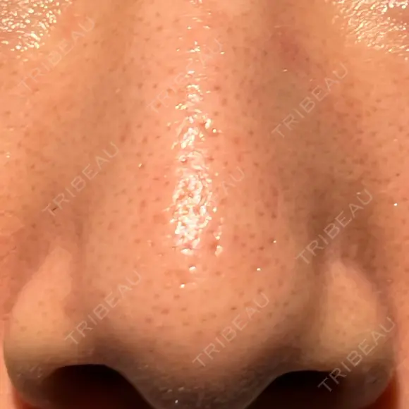 アグネス 日本美容・医療クリニック 六本木院 BEFORE メイン用