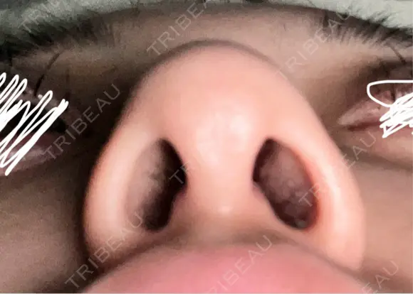 鼻尖形成（切開） / 小鼻縮小（切開） / 軟骨移植 / 鼻尖縮小 東京シンデレラ美容外科 新宿院 BEFORE メイン用