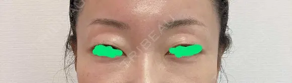 眉下切開 Barbie Clinic BEFORE メイン用