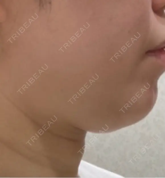 脂肪吸引（顔） / 眉下切開 / ヒアルロン酸注入（首） 春山記念病院 BEFORE メイン用