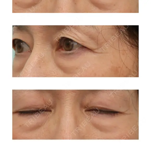 下まぶたたるみ取り WOM CLINIC GINZA （ワム クリニック ギンザ） BEFORE メイン用