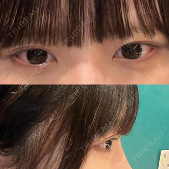 ヒアルロン酸注入（涙袋） / ヒアルロン酸注入（唇） HAAB×DREAM BEAUTY CLINIC 大阪梅田院 BEFORE メイン用