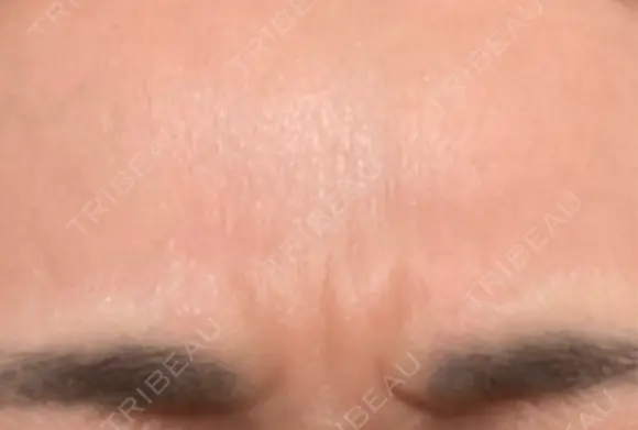 ボトックス（目尻） / ボトックス（額） 東京美容医療クリニック 池袋院 BEFORE メイン用