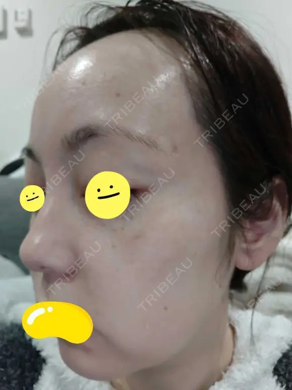 水光注射（ハリ・美肌） / 肌育注射（ジュベルックなど） Chloe Cheongdam Clinic （クロエチョンダムクリニック） BEFORE メイン用