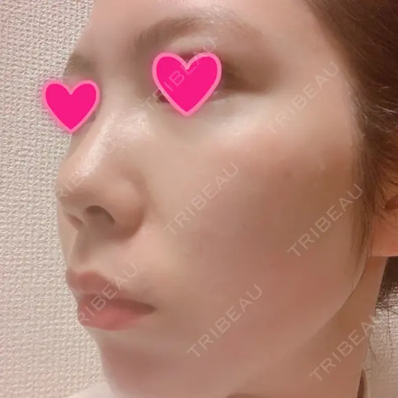 クマ治療 / 額を丸く / 脂肪吸引（脚） / レディエッセ注入（鼻） THE CLINIC（ザ・クリニック） 東京院 BEFORE メイン用