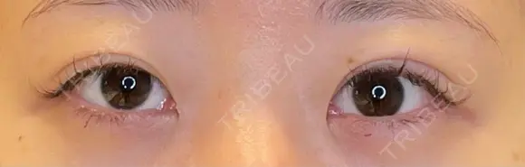 目尻切開 / タレ目形成・グラマラスライン（埋没） / 美容点滴・美容注射（美肌） LOUIS CLINIC 二子玉川院【ルイクリニック】 BEFORE メイン用