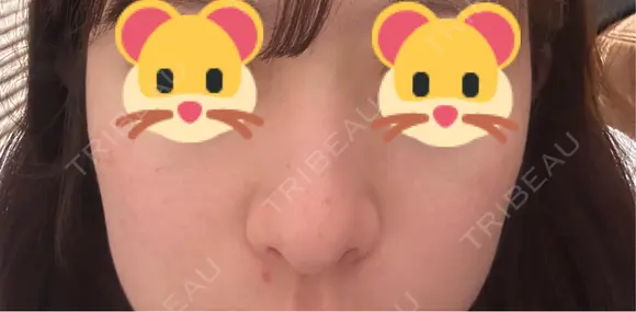 軟骨移植 / 目元修正 / 自然癒着法 / 鼻尖形成（非切開） eクリニック 福岡院 BEFORE メイン用