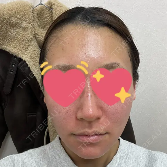 ニードルRF（ポテンツァなど） / ポテンツァ BAO CLINIC 神戸院 BEFORE メイン用