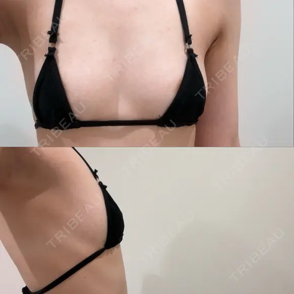 豊胸（脂肪注入） アムルーズ美容外科クリニック 横浜院 BEFORE メイン用