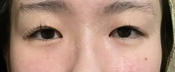 二重埋没 / 上まぶたの脂肪取り THE FIRST CLINIC 多摩センター院 BEFORE メイン用