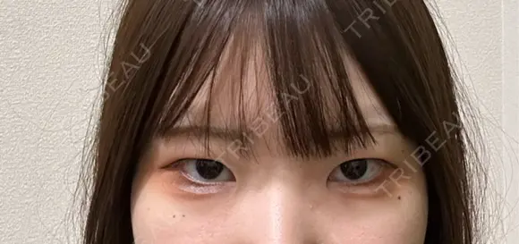二重埋没 / 目頭切開 / 上まぶたの脂肪取り 9BeautyClinic BEFORE メイン用