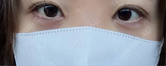 ヒアルロン酸注入（涙袋） AI Beauty Clinic （エーアイ美容クリニック） BEFORE メイン用