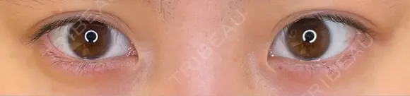 二重埋没 / タレ目形成・グラマラスライン（埋没） LOUIS CLINIC 二子玉川院【ルイクリニック】 BEFORE メイン用