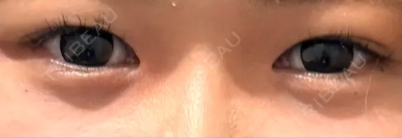 二重埋没 9BeautyClinic BEFORE メイン用