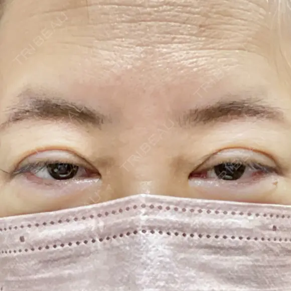 眼瞼下垂（切開） 博多もへじのクリニック BEFORE メイン用