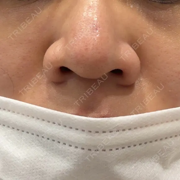 ベビーコラーゲン しのぶ皮膚科 BEFORE メイン用