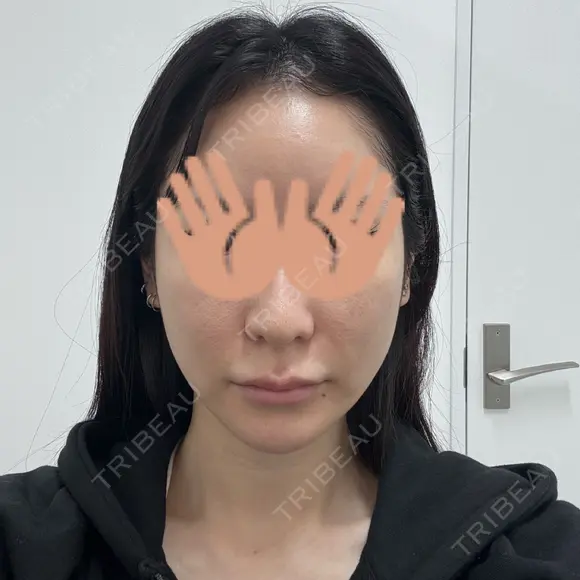 糸リフト / ボトックス（肩） / ワキ汗治療（ボトックス） DMTC CLINIC 日本橋院 BEFORE メイン用