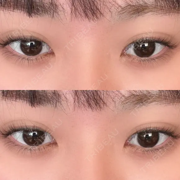 ヒアルロン酸注入（涙袋） / ボトックス（エラ・小顔） フィラークリニック 大阪心斎橋院 BEFORE メイン用