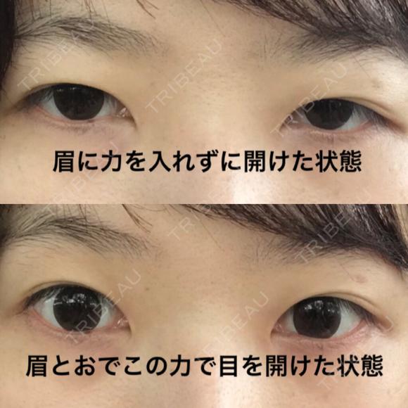 二重切開 / 眼瞼下垂（切開） 芦屋美容クリニック 芦屋院 BEFORE メイン用