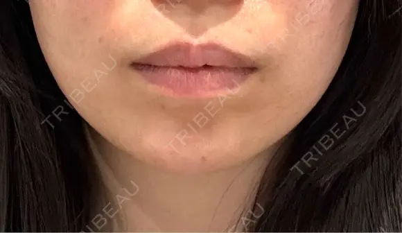 その他（輪郭） ライブリークリニック 浜松町院 BEFORE メイン用