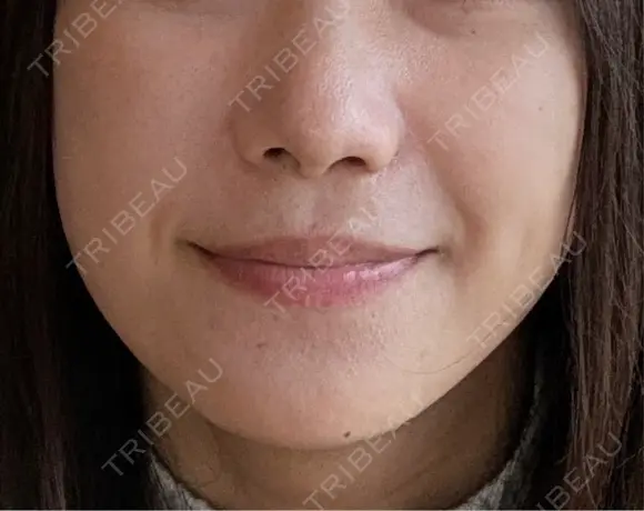 ヒアルロン酸注入（鼻翼基部） KIMI CLINIC 形成・美容外科 BEFORE メイン用