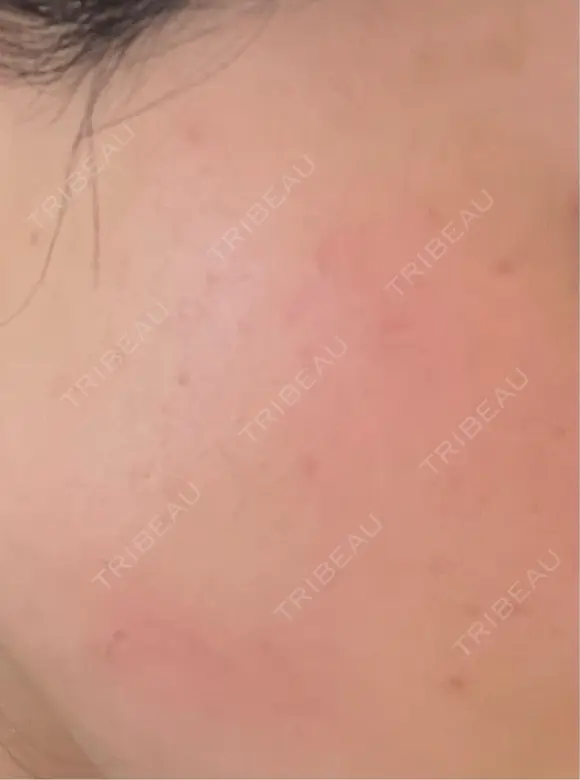 レーザートーニング（美白・肝斑） セカジソウォン医院-明洞店 BEFORE メイン用