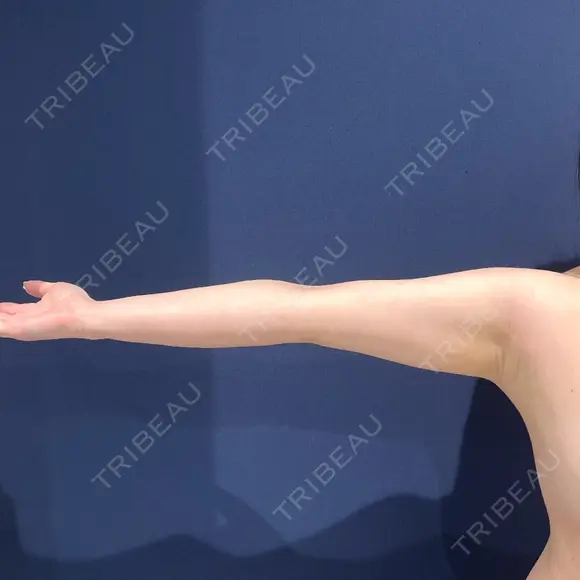 糸リフト / 脂肪吸引（顔） / 脂肪吸引（二の腕） / ワキ汗治療（切開） / 脂肪吸引注射（顔） ICON CLINIC BEFORE メイン用