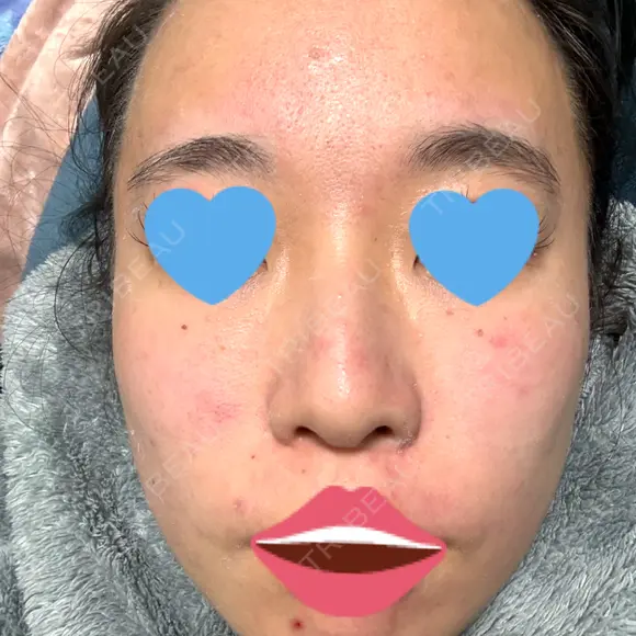 ダーマペン / PRP皮膚再生療法 / ヴァンパイアフェイシャル 筋肉・美容クリニック BEFORE メイン用