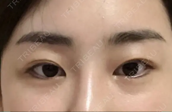 二重埋没 / 眼瞼下垂（切開） / 目尻切開 / 蒙古ひだ形成 / タレ目形成・グラマラスライン（切開） POP美容整形クリニック BEFORE メイン用
