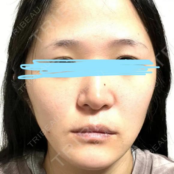 小鼻縮小（切開） / 鼻翼基部形成（貴族手術） 新宿ラクル美容外科クリニック 新宿院 BEFORE メイン用
