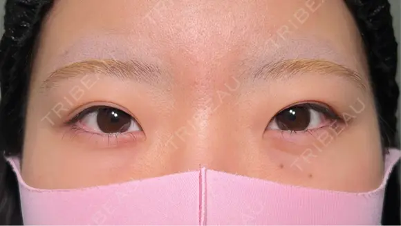 二重埋没 / 目頭切開 HAAB×DREAM BEAUTY CLINIC 大阪梅田院 BEFORE メイン用