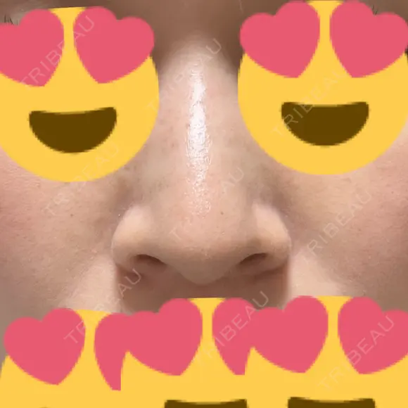 小鼻縮小（切開） アネシス美容クリニック BEFORE メイン用