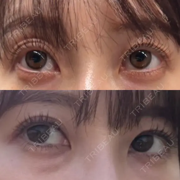 クマ治療 / 下まぶたの脂肪取り APOLLO BEAUTY CLINIC BEFORE メイン用