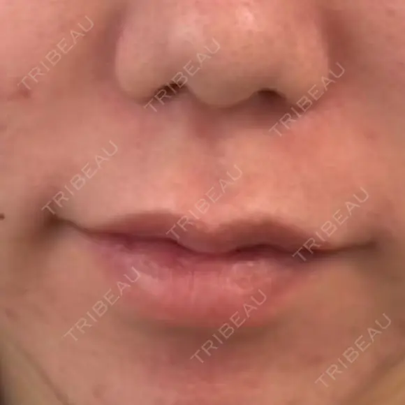 ヒアルロン酸注入（唇） L‘amour clinic Tokyo【ラムールクリニック東京】 BEFORE メイン用