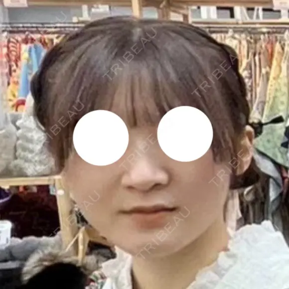 鼻尖形成（切開） / 軟骨移植 / 鼻柱下降・鼻唇角形成（猫手術） 東京美専クリニック BEFORE メイン用