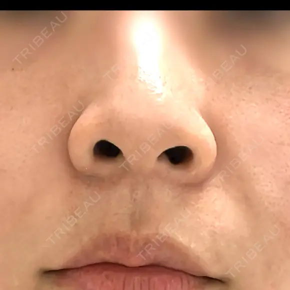 鼻尖形成（切開） / 小鼻縮小（切開） / 軟骨移植 / 鼻柱下降・鼻唇角形成（猫手術） / その他（鼻） 東京シンデレラ美容外科 池袋院 BEFORE メイン用