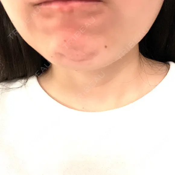 ボトックス（あご） / ボトックス（エラ・小顔） / ボトックス（眉間） TCB東京中央美容外科 枚方院 BEFORE メイン用