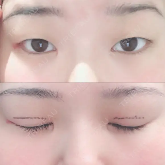 二重埋没 湘南美容クリニック 松山院 BEFORE メイン用