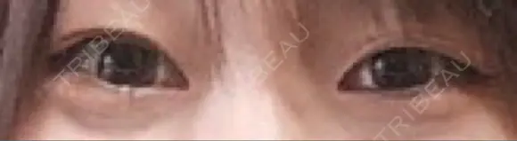 二重埋没 城本クリニック 姫路院 BEFORE メイン用