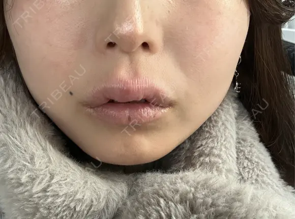 アートメイク（唇） 表参道メディカルクリニック 名古屋院 BEFORE メイン用