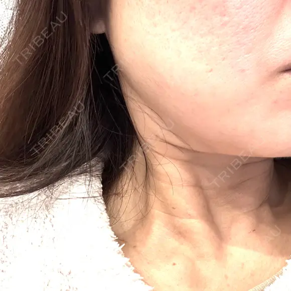 その他（輪郭） ルラ美容クリニック 大宮院 / ルラスキンクリニック 大宮院 BEFORE メイン用